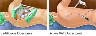 traditionele methode versus VATS Lobectomie